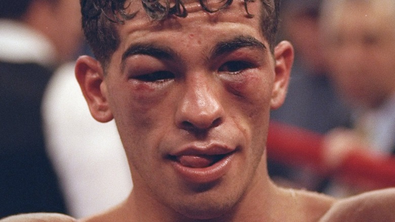boxer arturo gatti after fight