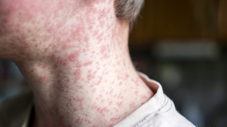 neck and cheek with measles rash