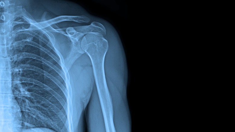 xray of a shoulder