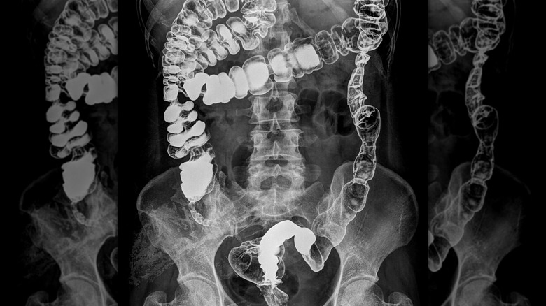 X-ray of lower intestinal tract