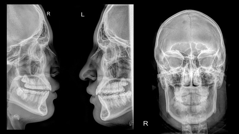 x-ray of head with nose fracture