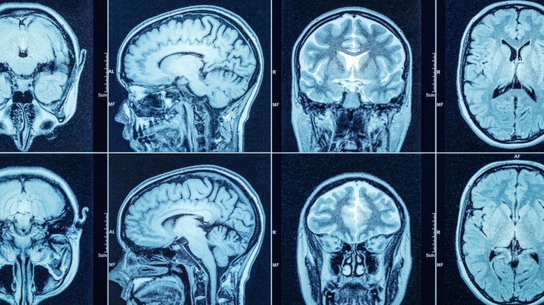 x-ray of human brain
