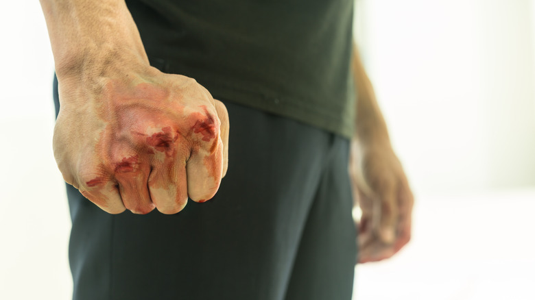 A hand with bloody knuckles