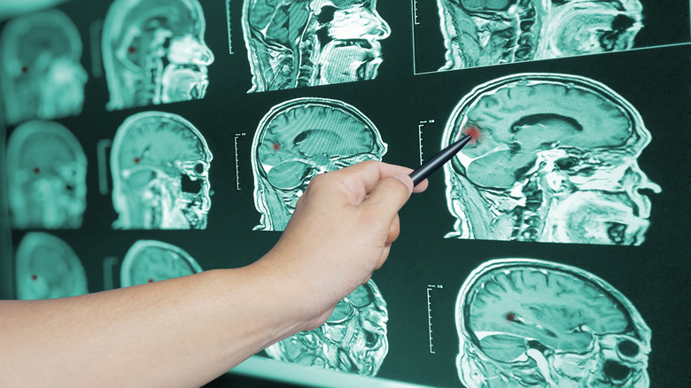 A brain scan