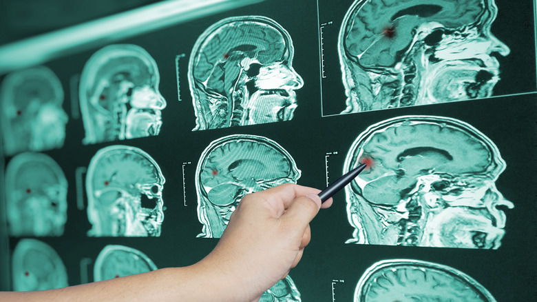 cat scans of a brain