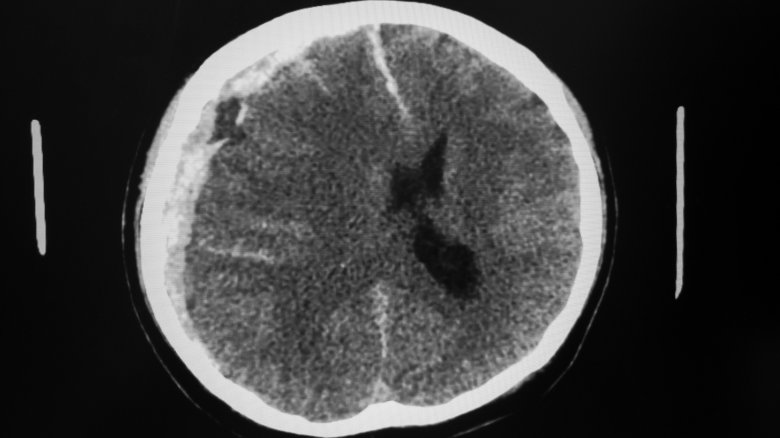 Subdural hematoma