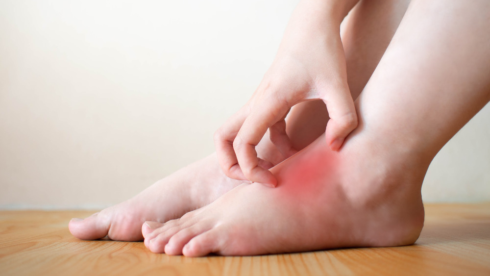 redness burning in feet hands