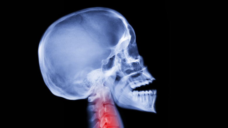 X-ray of skull in profile