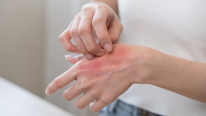 Red skin on woman's hand