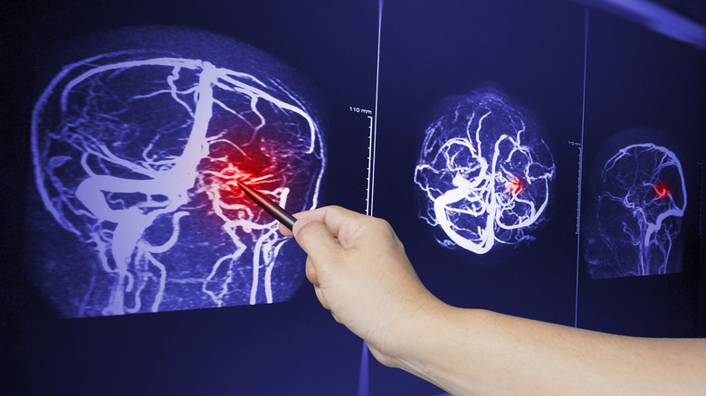hand pointing to brain scan