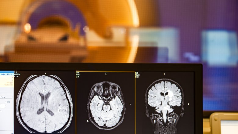 brain scan mri