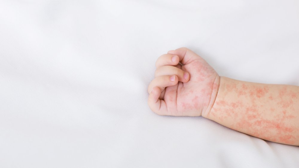 Measles, deadly virus