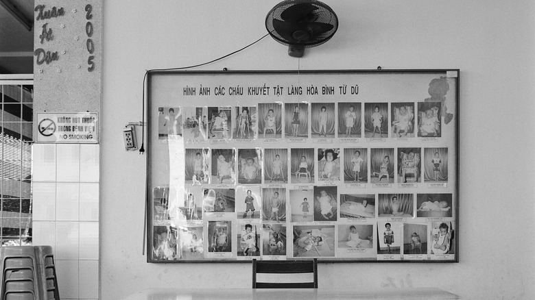 pictures of children with birth defects at vietnamese hospital