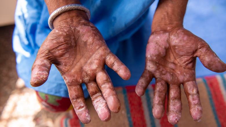 Leprosy patient 