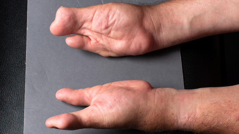 Thalidomide birth defects hand