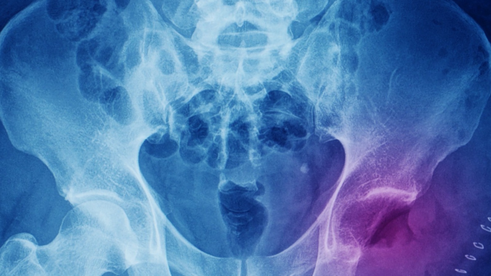 The Disturbing Truth Of What Was Found In Albert Fish's XRay