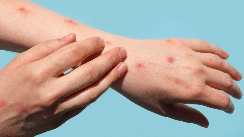 Close-up of arms with pox lesions