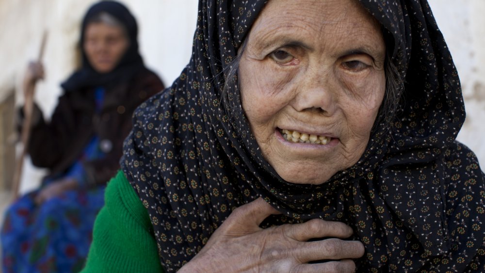 Woman with leprosy