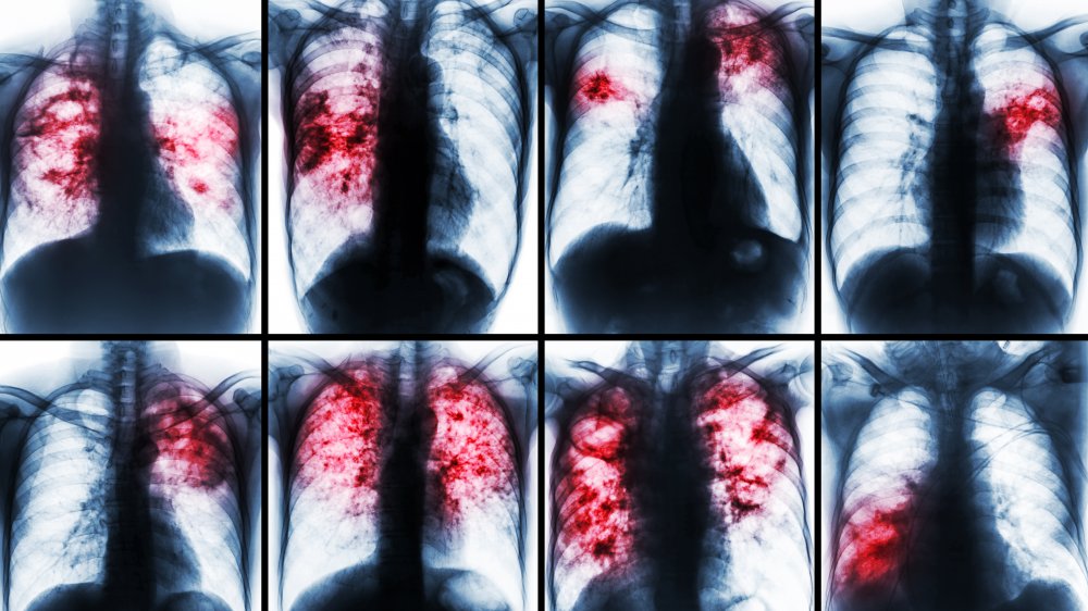 Pulmonary Tuberculosis Collection . Chest X-ray show patchy infiltration , interstitial infiltration , alveolar infiltration , cavity , fibrosis at lung due to Mycobacterium tuberculosis infection .