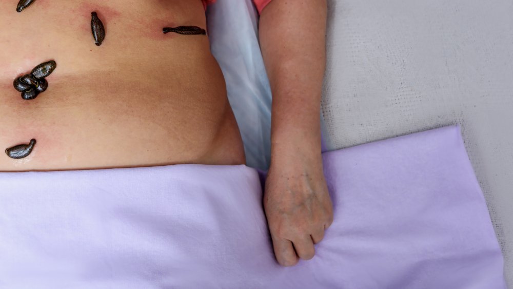 blood-sucking leeches on woman's stomach
