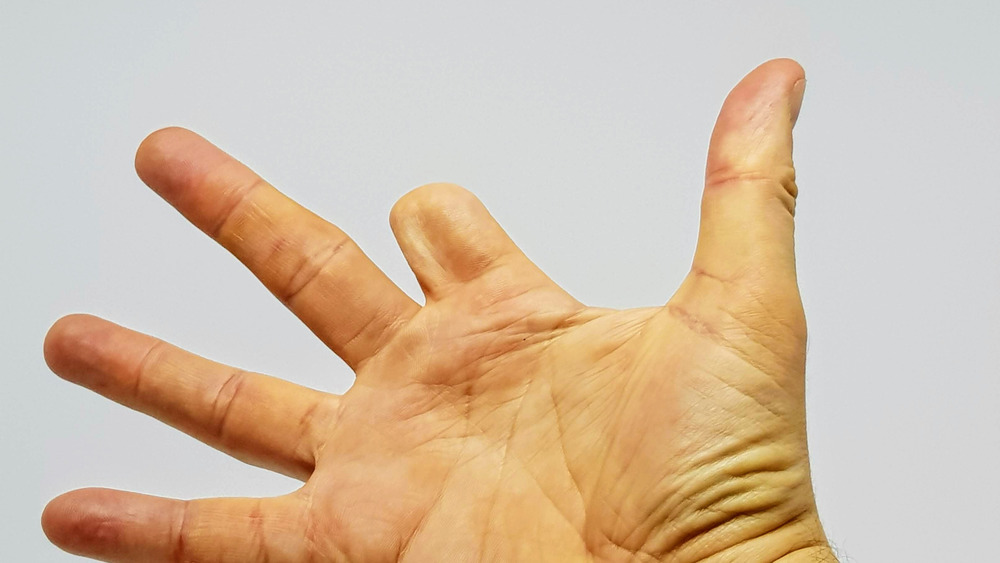 Hand with amputated finger