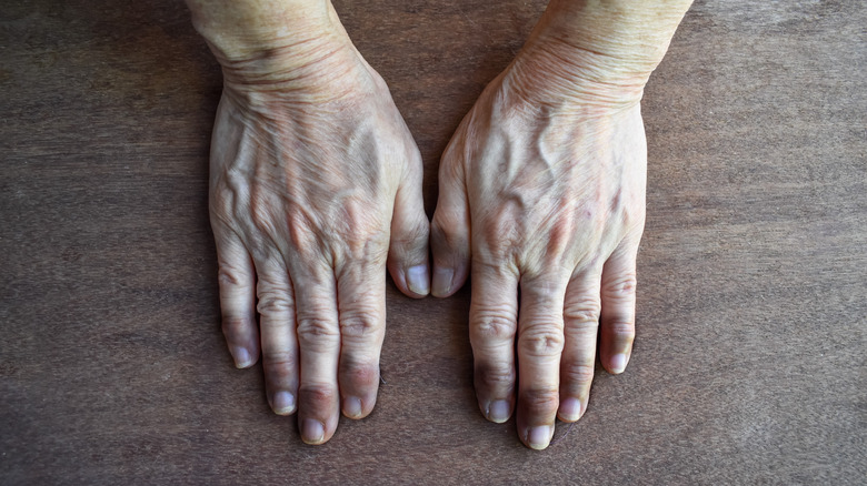 Cyanotic hands on wood surface