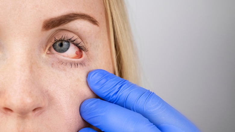 gloved hand stretching woman's red eye