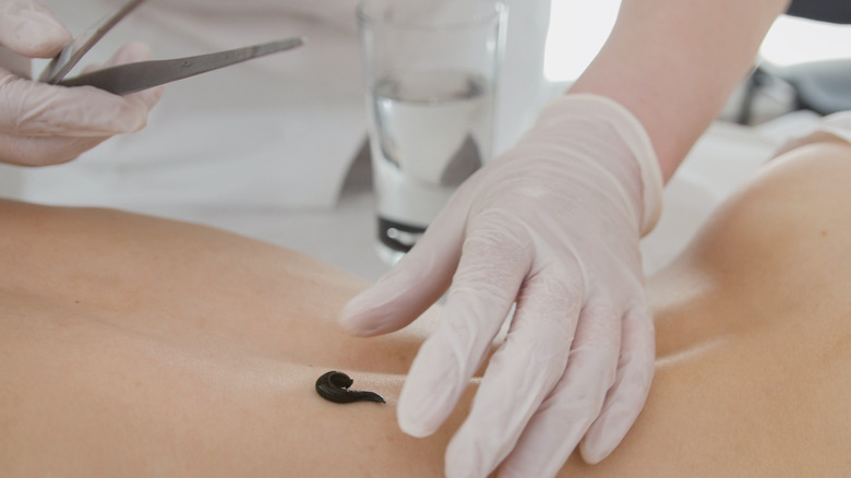 Doctor puts on leech on woman