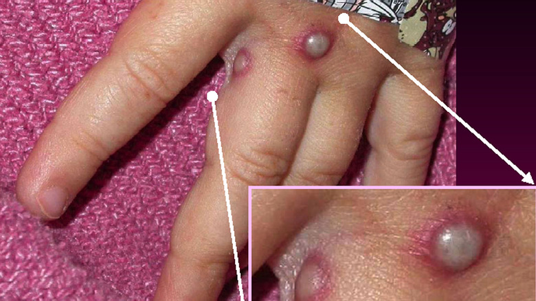 monkeypox lesion from 2003 