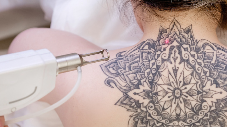 Tattoo removal procedure
