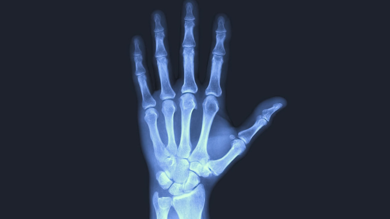 x-ray of human hand