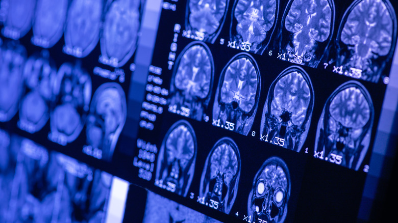 Brain scan images.