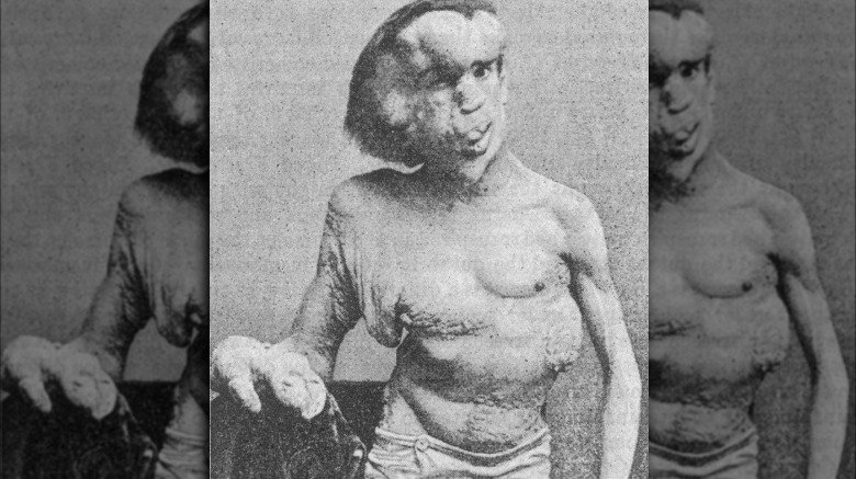 Joseph Merrick "the Elephant Man"