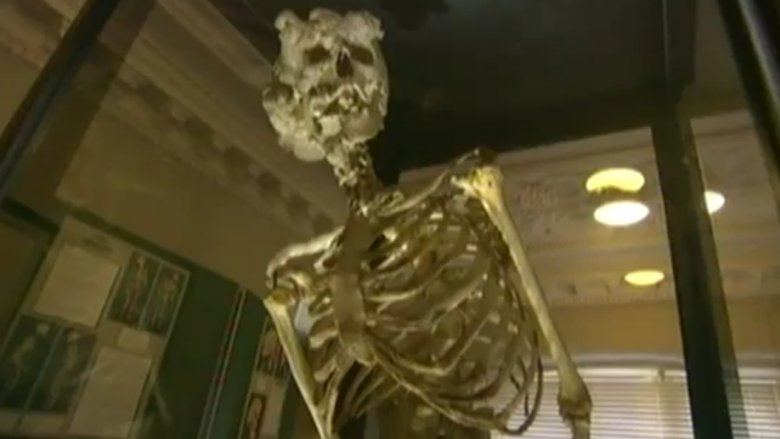 Joseph Merrick's bones