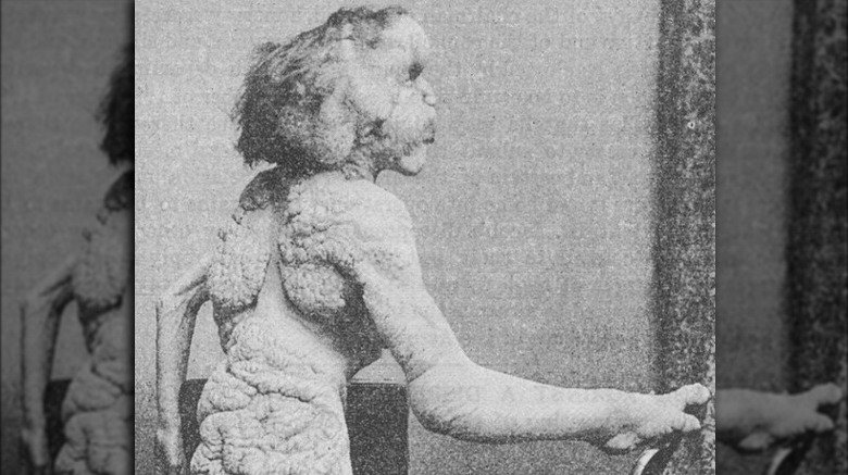 Joseph Merrick "the Elephant Man"