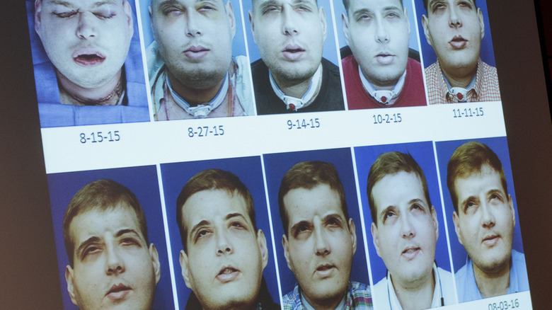 face transplant recovery timeline