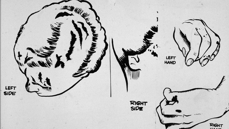 Illustrations of Marilyn Sheppard's wounds 