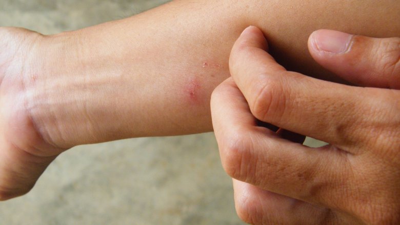 Mosquito bites