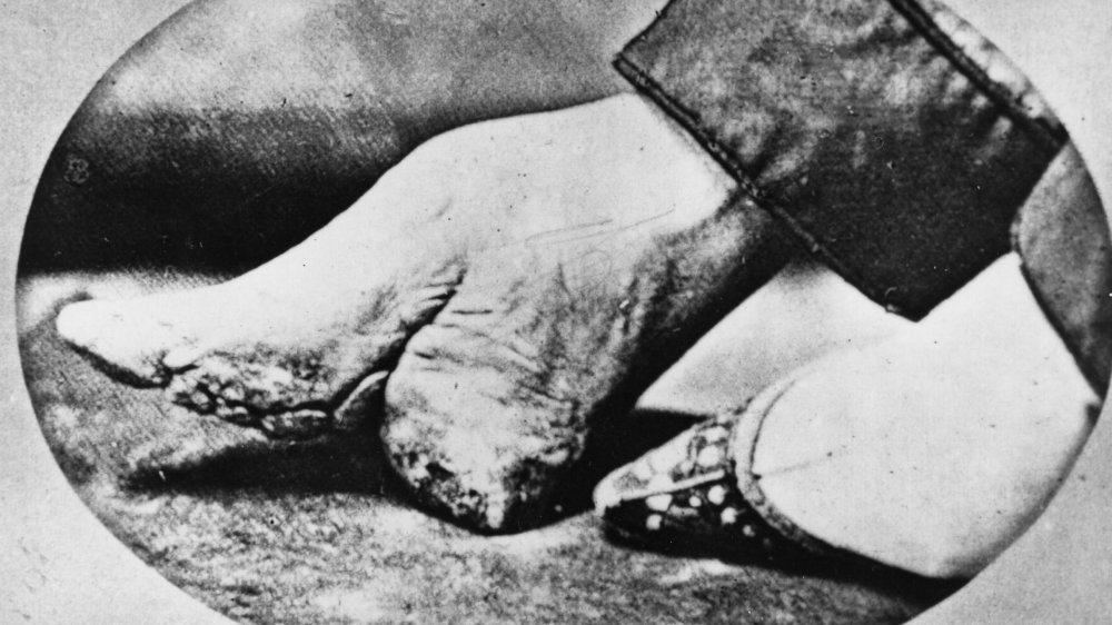 foot binding