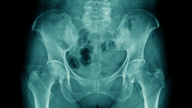 X-ray of pelvis