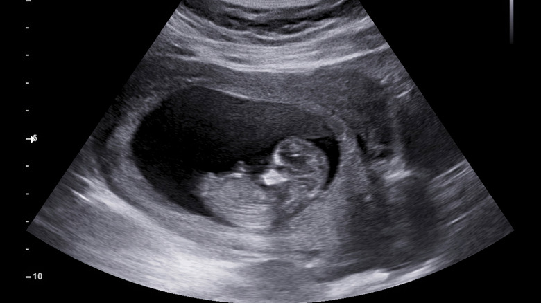 Ultrasound of 12 week fetus