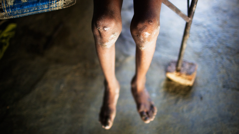 Bhopal gas tragedy sores on legs