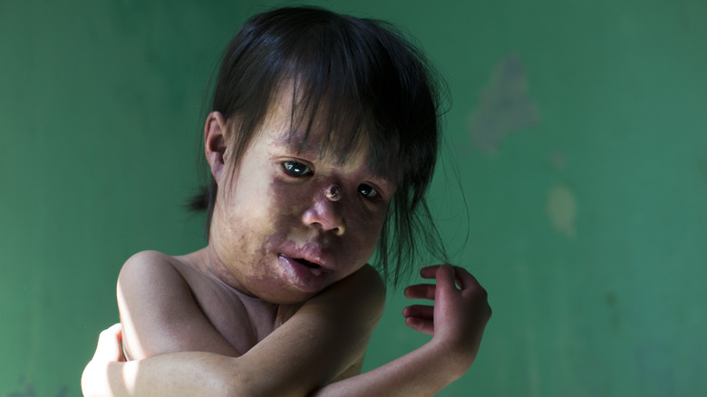 A Southeast Asian child deformed by Agent Orange