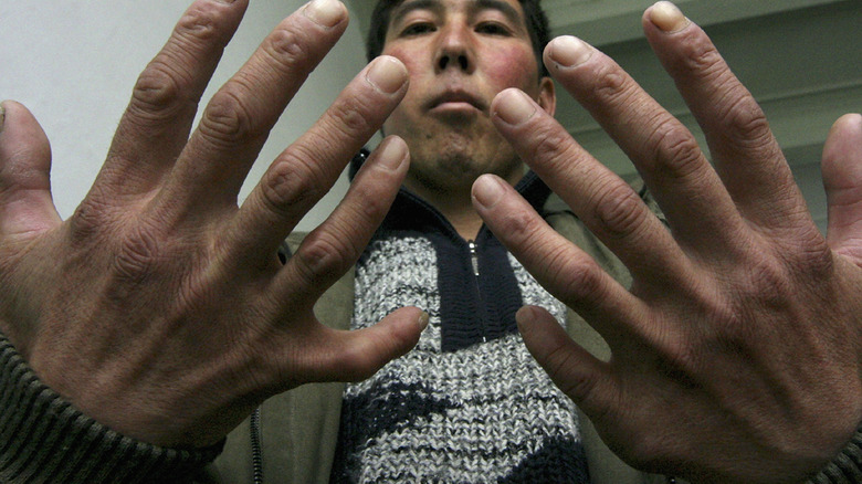 Man with additional fingers