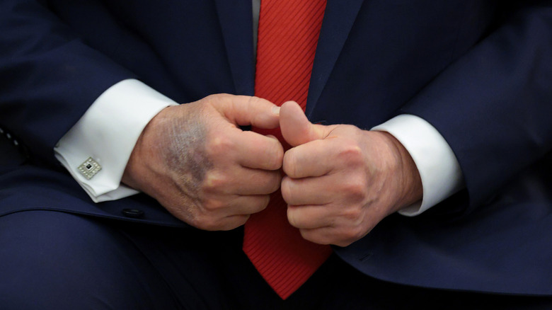 Donald Trump's bruised hands