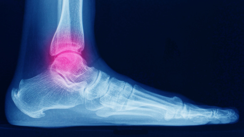 Xray of a human foot
