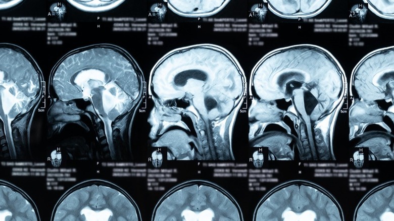 brain scans showing hydrocephaly 