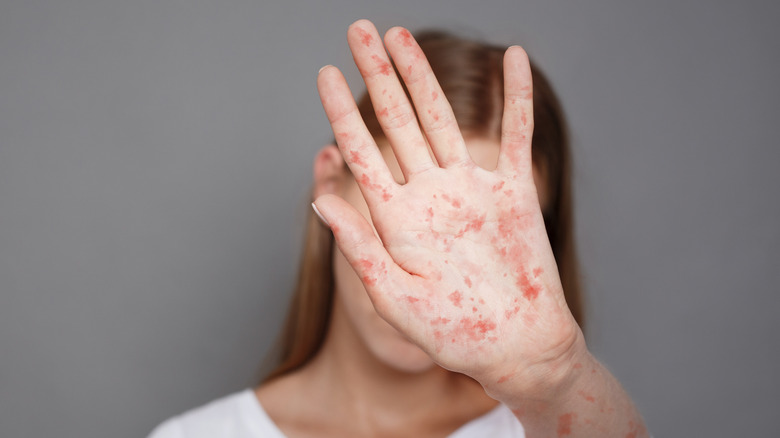 Child with measles infection