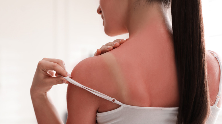 Woman with sunburn on back