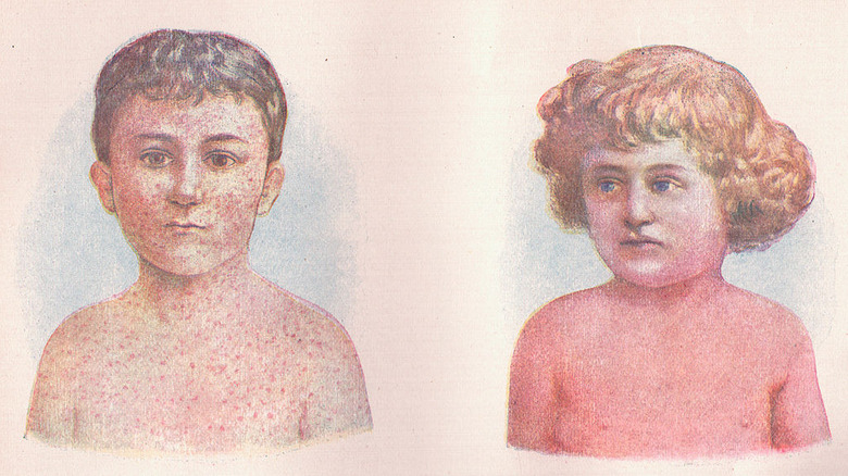 Measles and Scarlet Fever example